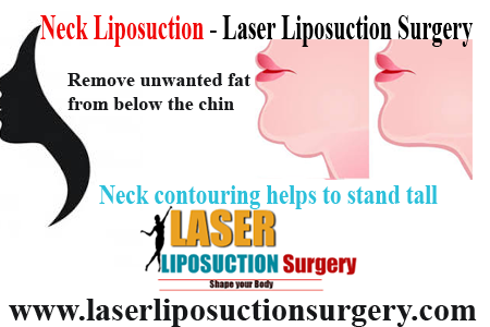 Neck Liposuction - Laser Liposuction Surgery