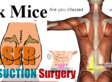 back mice - laser liposuction surgery