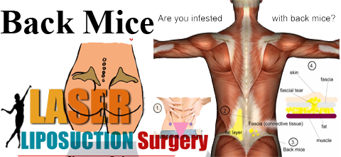 back mice - laser liposuction surgery
