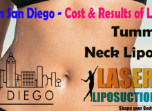 Liposuction San Diego - Cost & Results of Liposuction