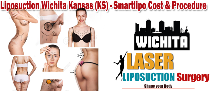 Liposuction Wichita Kansas (KS) - Smartlipo Cost & Procedure