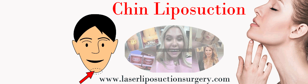 Chin Liposuction