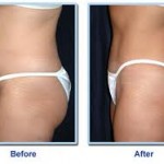 Beautifil Liposuction Buttocks - Your Choice