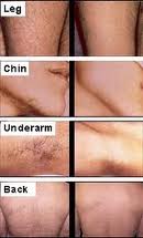 Laser Hair Removal Surgery