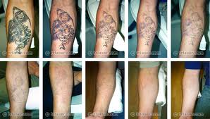Laser Tattoo Removal - Your Best Option for Tattoo Removal