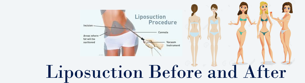 Liposuction Cost