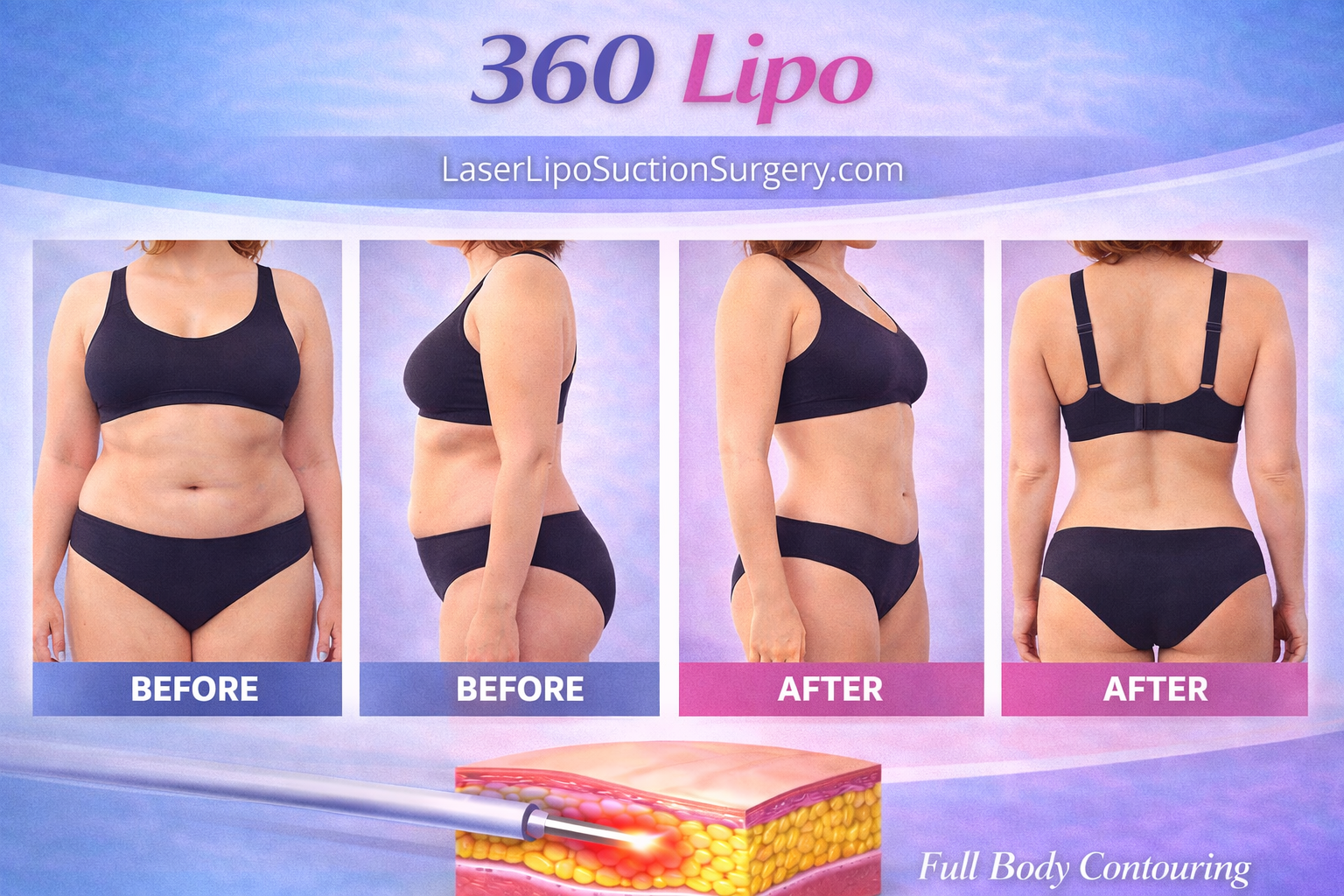 360 Lipo laser liposuction area
