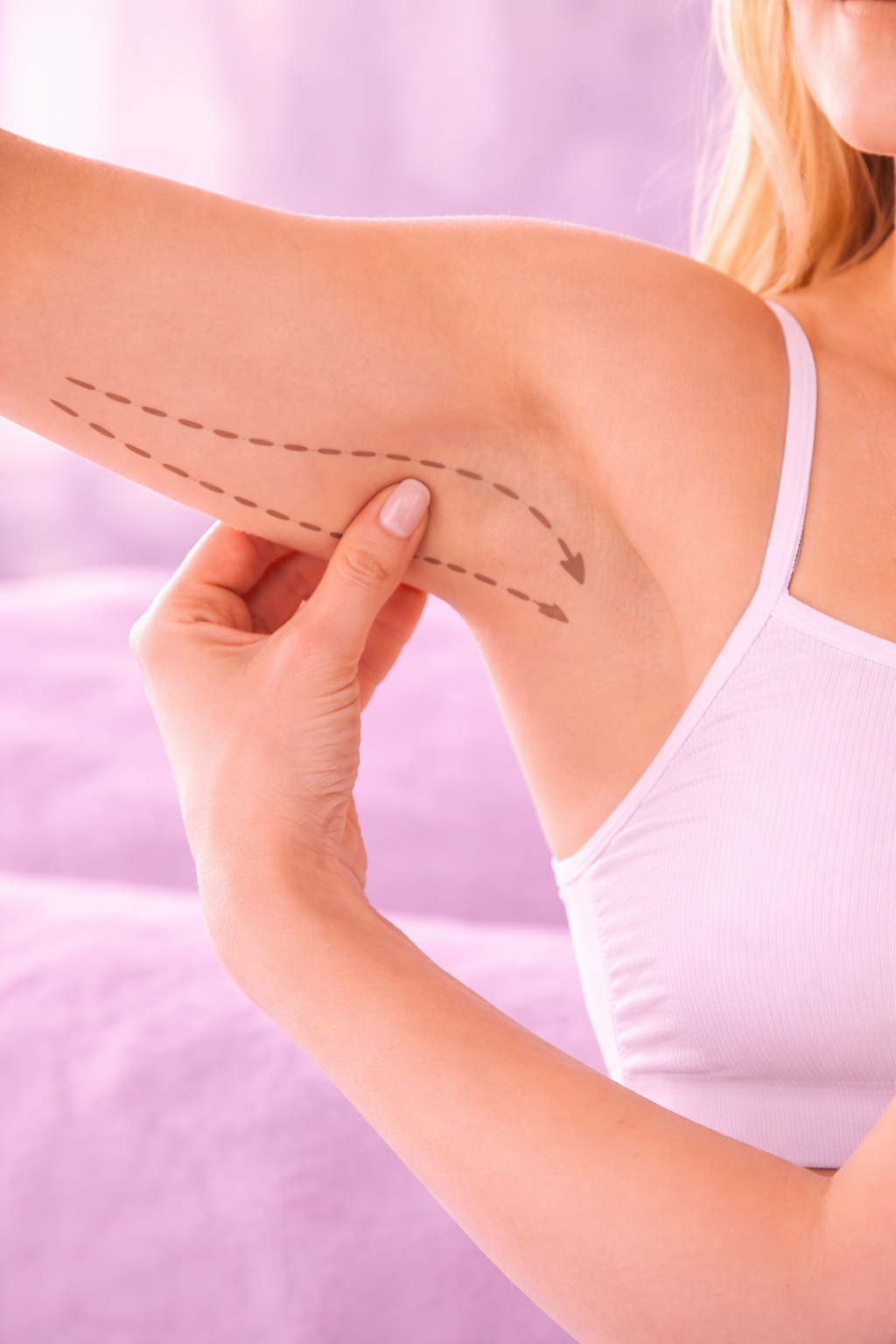 Arms laser liposuction treatment area