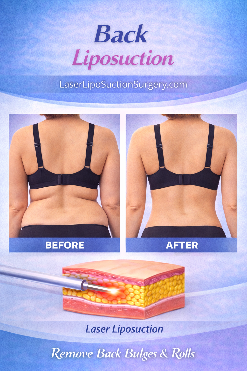 Back liposuction treatment area
